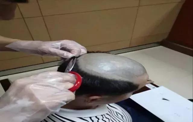 地中海脱发剃光头,主动剃光头的年轻人怎么了