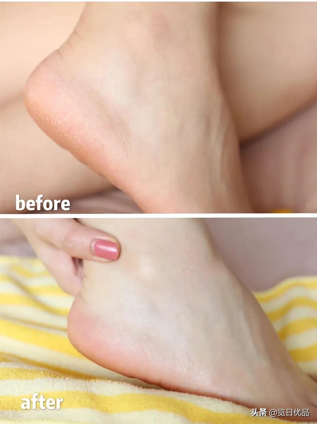 爽炸了!干丑裂的脚皮,一张完整撕掉,敢跟婴儿比姣嫩!