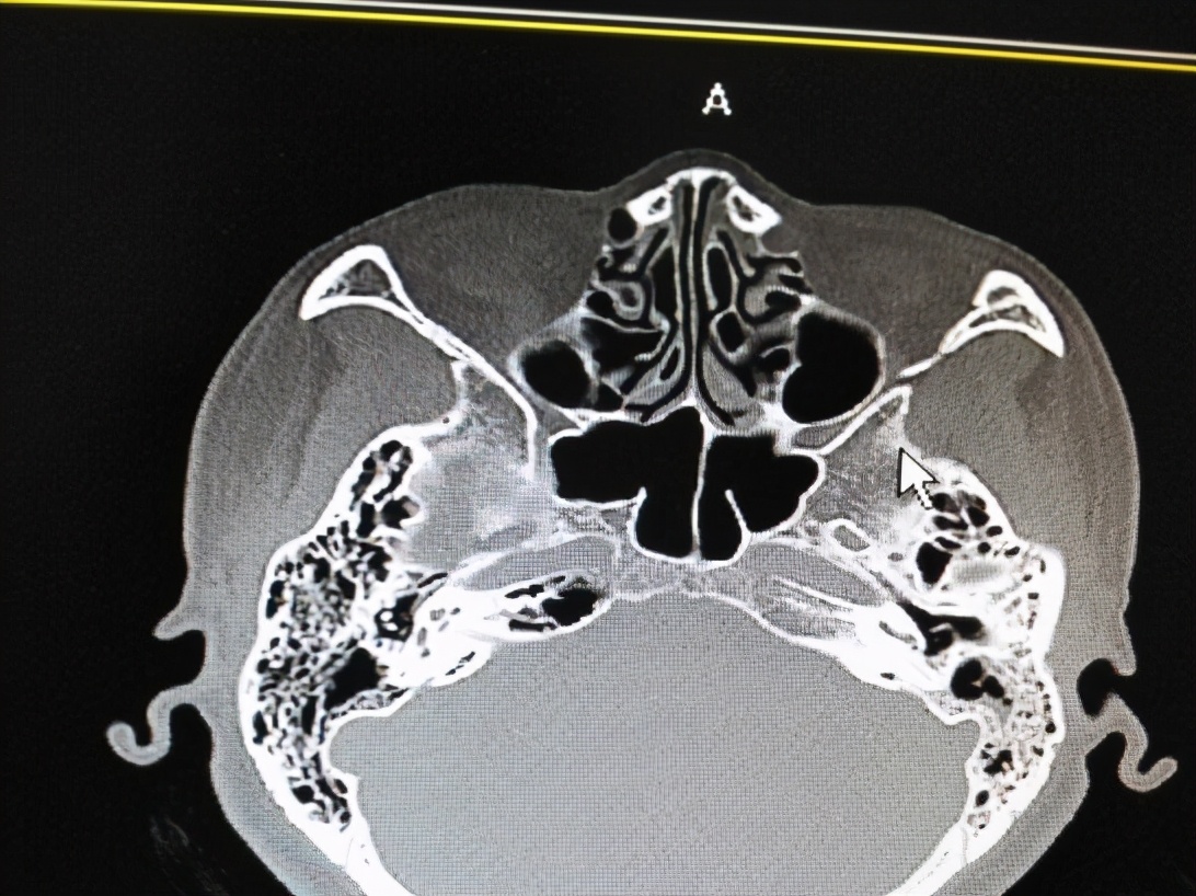 耳屎结成硬块一挖出血,耳屎结成硬块一掏就出血