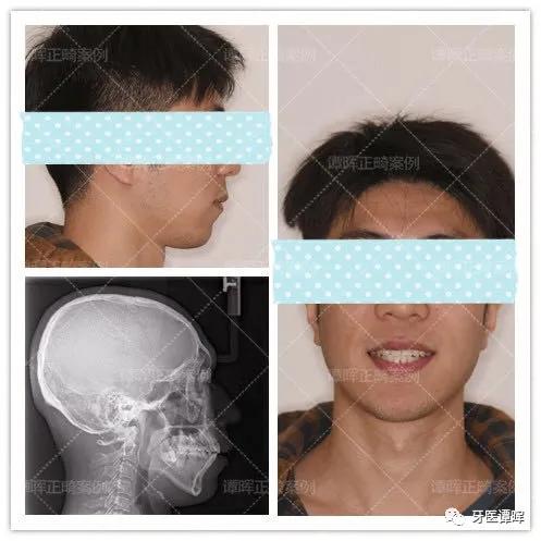 牙齿不齐牙列拥挤怎么矫正,牙列不齐拥挤矫正大约要多少钱