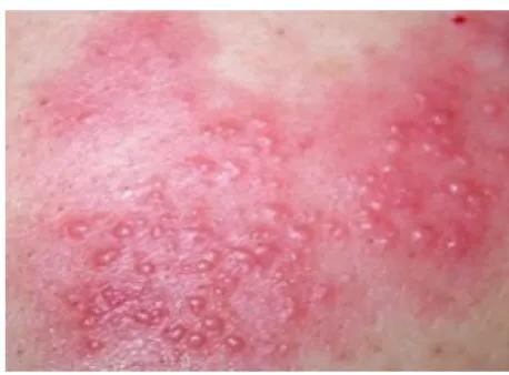 蛇串疮俗称叫什么,蛇串疮怎么得的