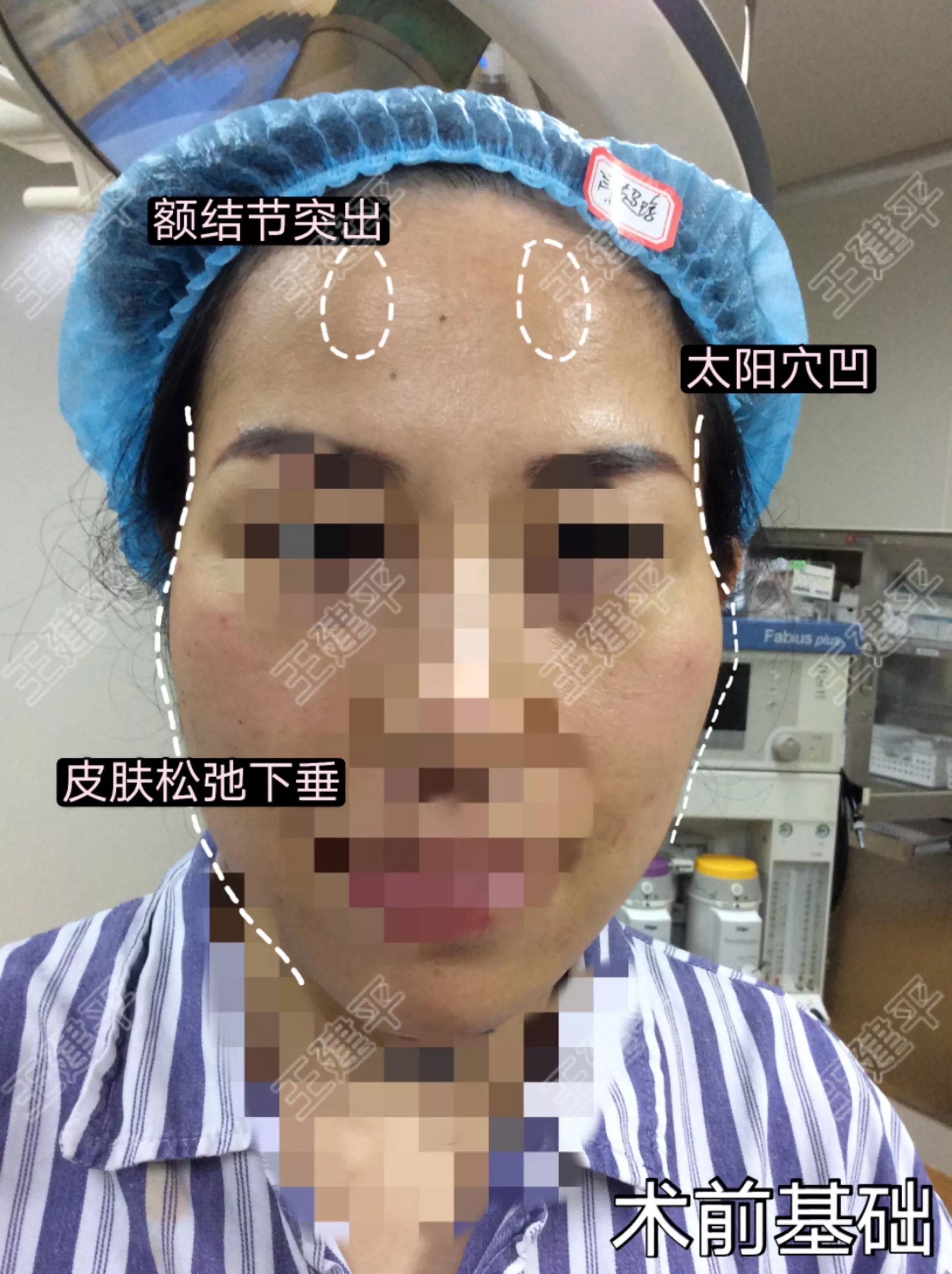 全脸填充真实视频,全脸填充是什么