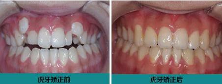 为什么会有长牙的情况,为什么有的人长牙快有的人长牙慢