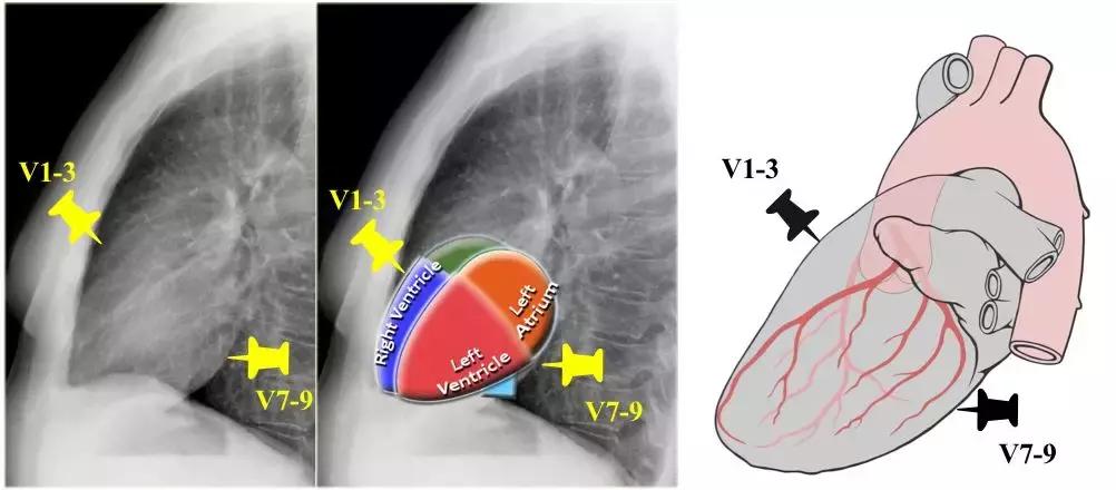 心电图和心脏彩超以哪个为准,心电图和心脏超声是一样吗