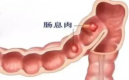 息肉也叫息肉肿物,息肉就是叫肉痣吗