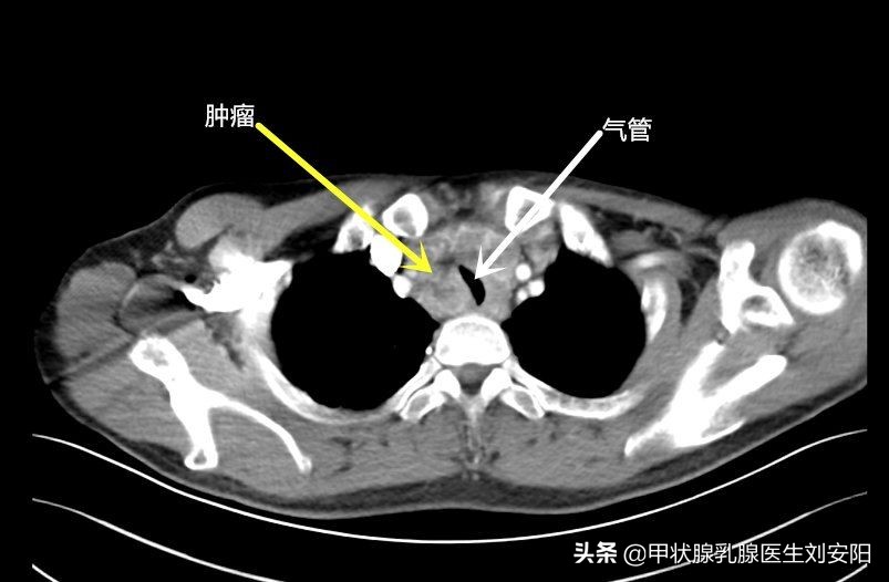甲状腺癌髓样癌的腹泻特点,甲状腺髓样癌一定腹泻吗