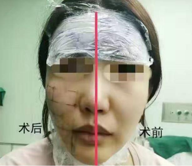 热玛吉抗衰技术可靠吗,超声炮和热玛吉哪个抗衰效果好