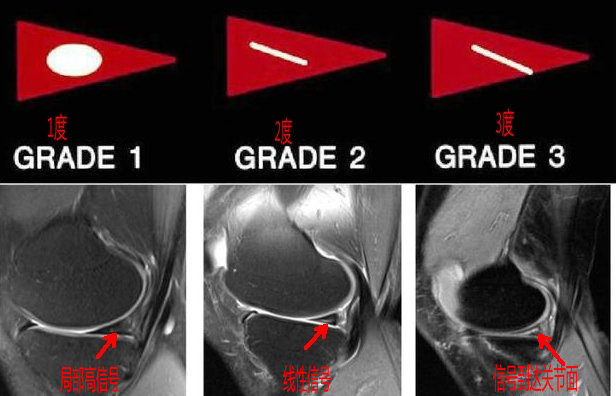 磁共振图片讲解半月板损伤的程度,磁共振半月板损伤严重