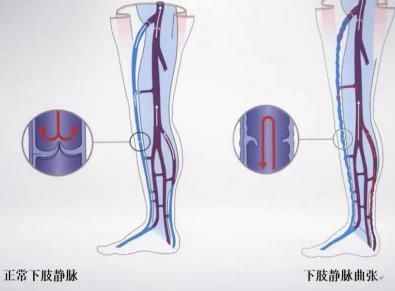 泡脚可以改善腿部的静脉曲张吗,艾叶加红花泡脚治疗静脉曲张偏方