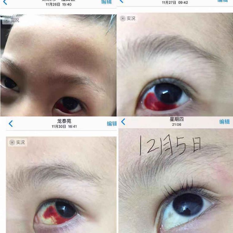 小孩眼睛受伤的最佳治疗时间,小孩眼睛受伤有小血点怎么消除