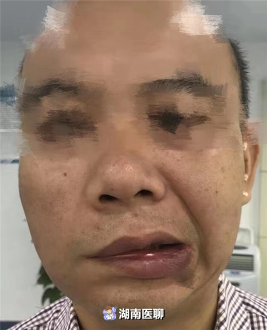 面瘫患者后遗症期间要天天扎针吗,面瘫扎针治疗有什么忌口