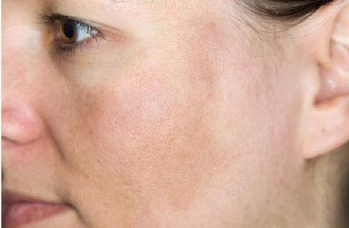 夏天晒黑怎么恢复美白,夏天晒黑了怎么快速变白