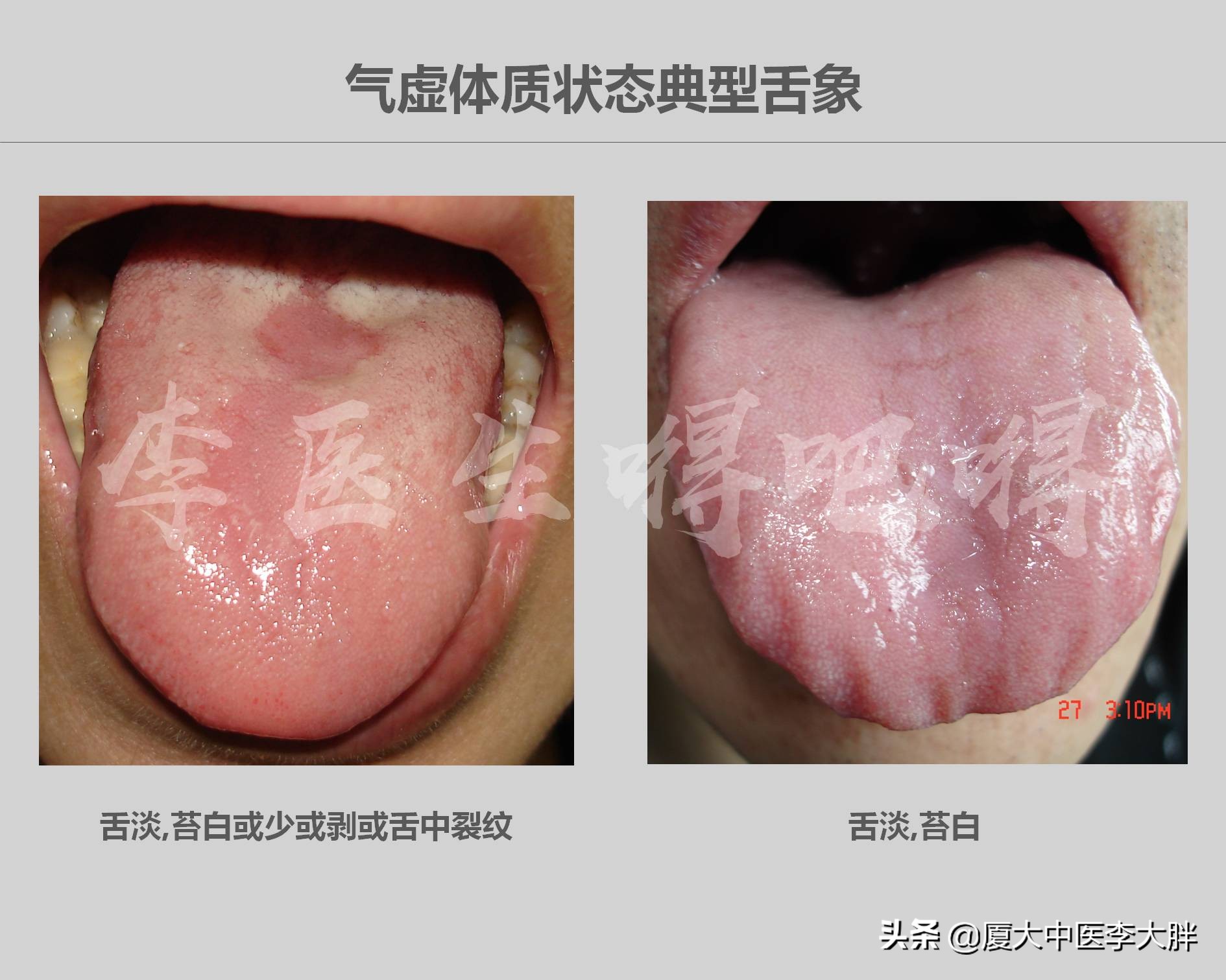 孩子气虚怎么调,气虚齿痕舌怎么调