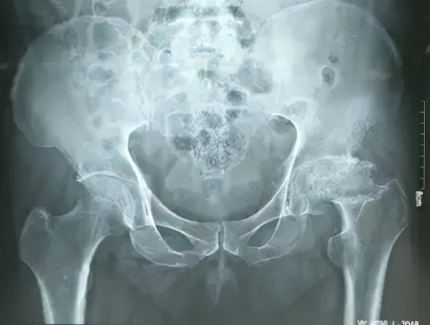 股骨头坏死和腰间盘突出症状区别,椎间盘突出和股骨头坏死症状区别