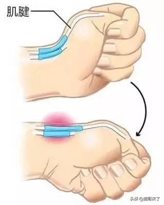 产后手腕疼痛解决方法,产后妈妈手腕疼是什么原因呢