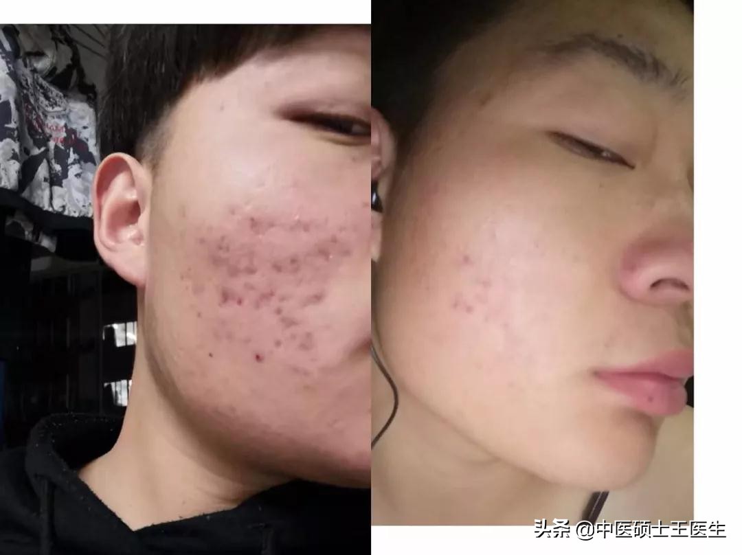 中医祛痘多少钱,中医祛痘挂什么科