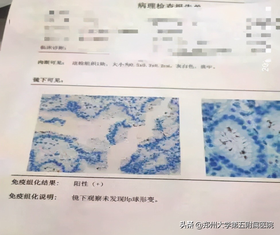 过敏性瘀斑怎么治疗,大面积瘀斑