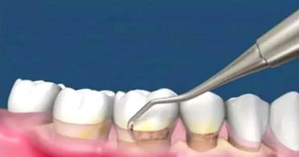 牙科的一些常识,牙科常见的问题和治疗方法