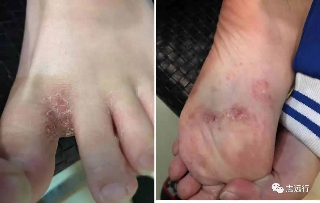 张景明治疗手足癣的中药方,一个治疗手足癣的好方子