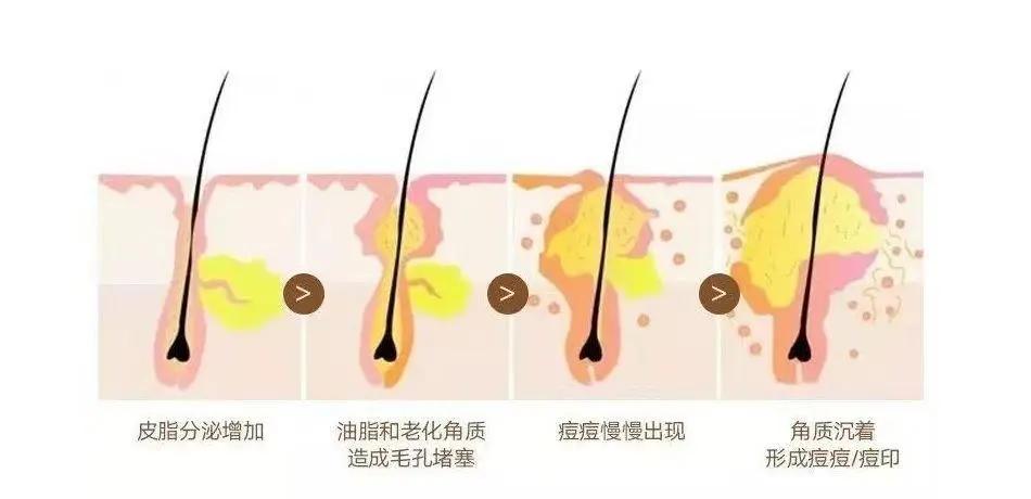 疥疮丘疹的成因,斑丘疹状皮损是什么病