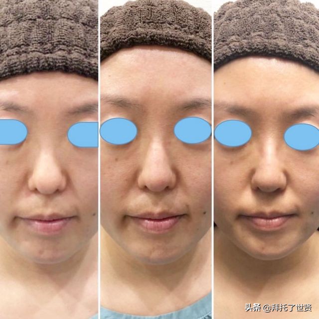 石原里美和佐藤健,石原里美整容之路