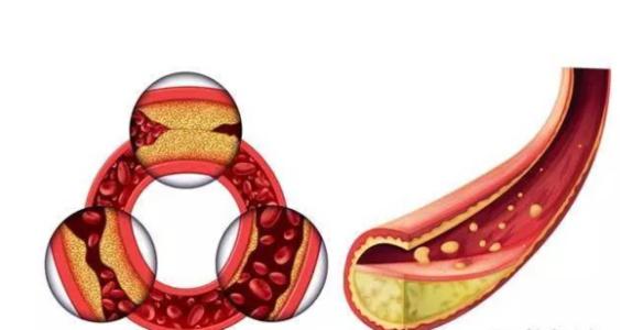 甘油三酯偏高需要注意些什么,甘油三酯偏高说明什么有问题