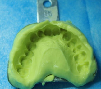 牙齿根管治疗全过程动画,牙齿第一次做完根管治疗