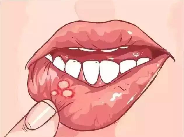 嘴巴淌口水导致嘴角溃疡怎办,嘴角溃疡长水泡怎么办