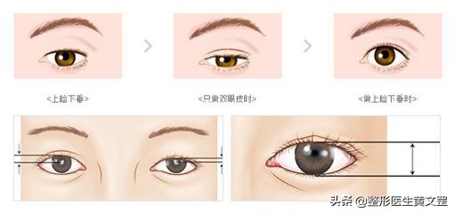 黑眼珠一定是圆吗,黑眼珠全部露出来眼睛大吗