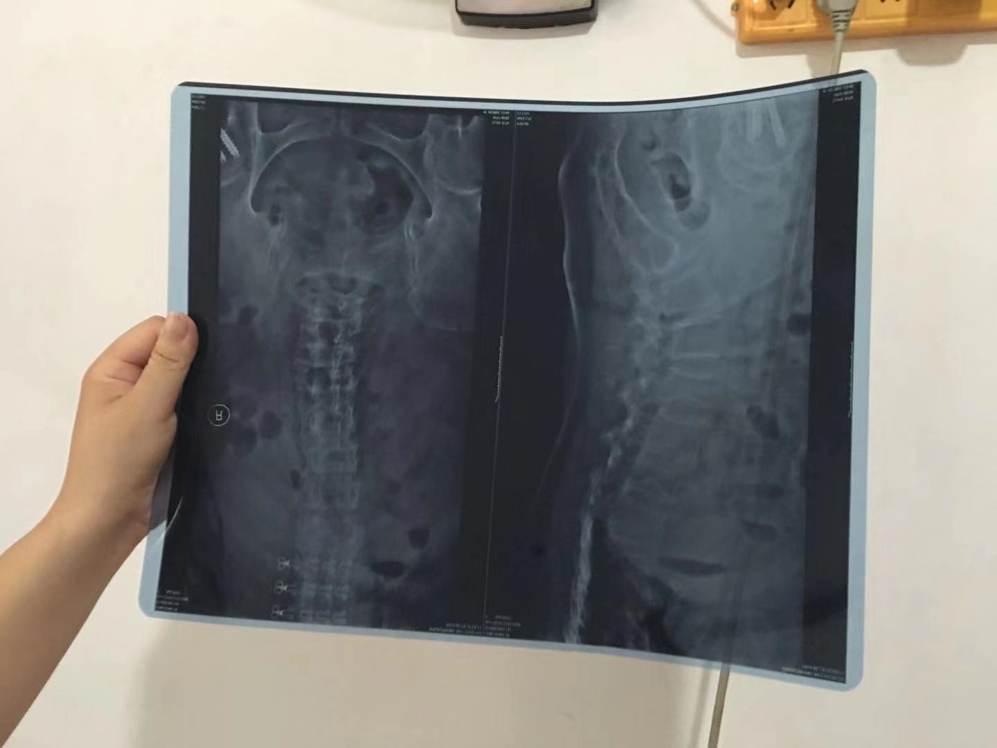 老年人半边腰痛怎么回事,老年人腰部摔伤疼痛怎么治疗