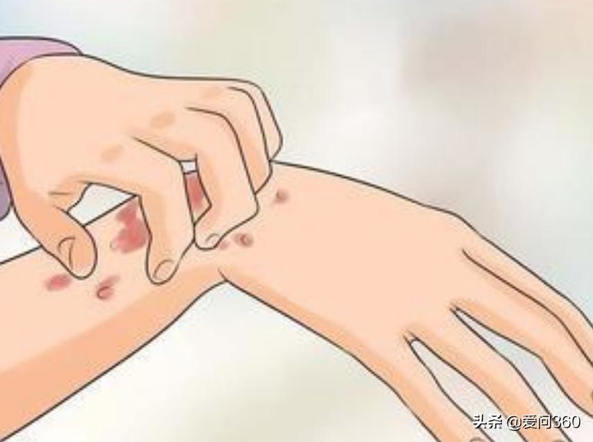 荨麻疹遇热重遇冷缓解怎么治,麻疹出现皮肤瘙痒用什么止痒