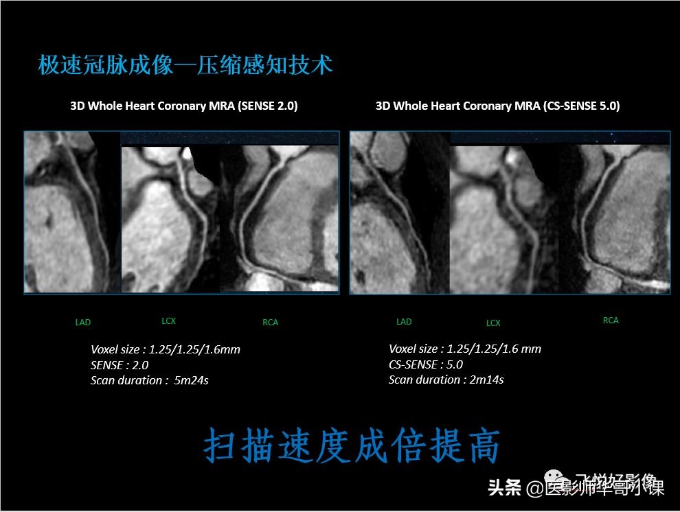 飞利浦核磁共振快速扫描,飞利浦磁共振心脏扫描
