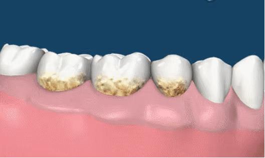 草莓籽藏在牙里发芽了,草莓籽在嘴里发芽