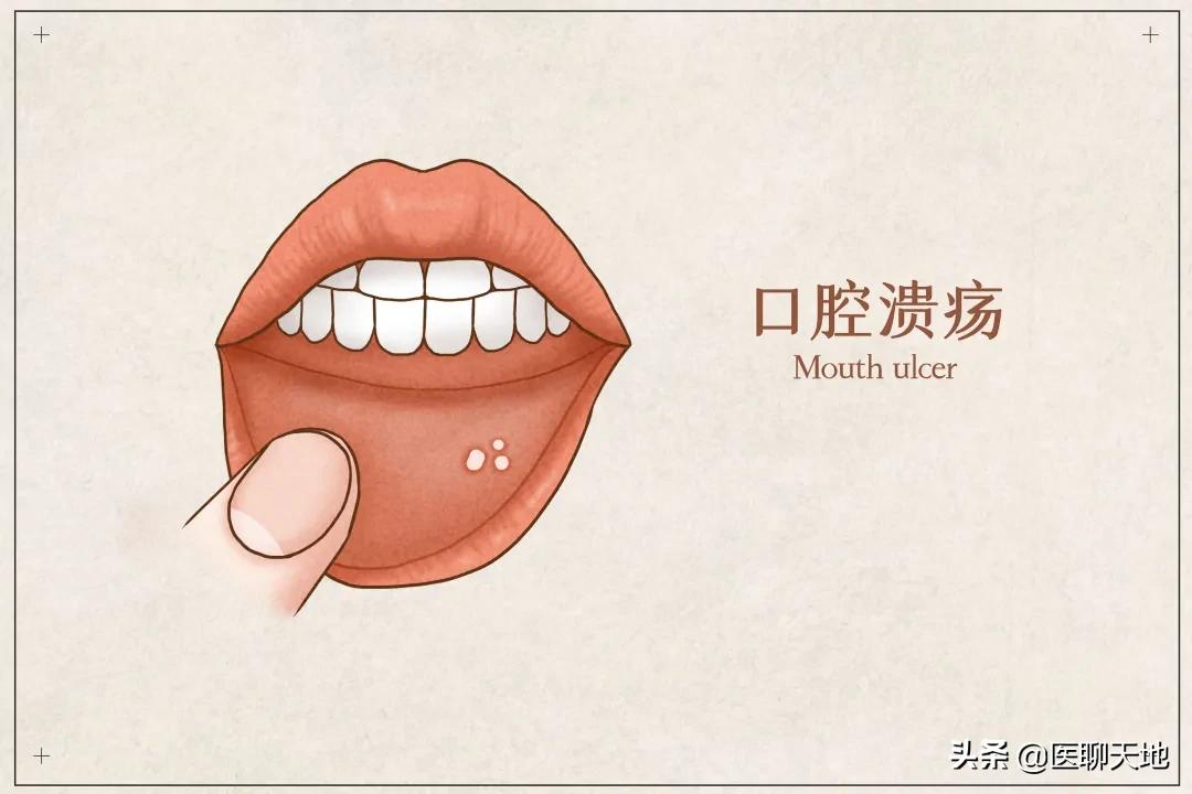 嘴巴内壁的肉痛怎么办,嘴巴里面好痛发炎怎么办