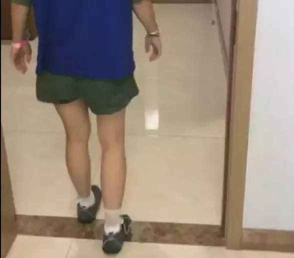 微创拇外翻手术有哪些后遗症,拇外翻微创手术效果好吗