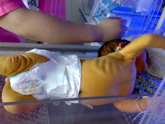 常见高危新生儿疾病课件,新生儿常见先天性疾病