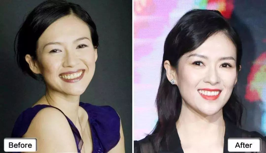 牙齿变色怎么办冷光美白全攻略