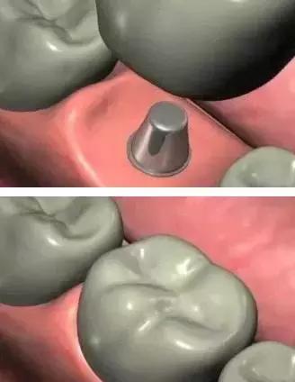 3d打印种植牙与传统种植牙的区别,种植牙是怎样种植的如何操作