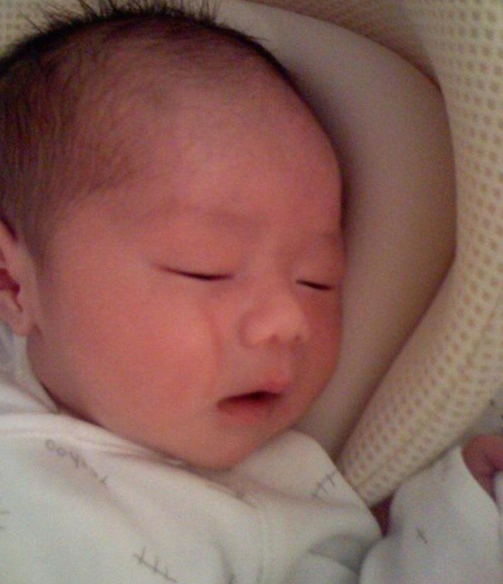 产钳孩子是不是一定有后遗症,产钳夹的印多久可以消失