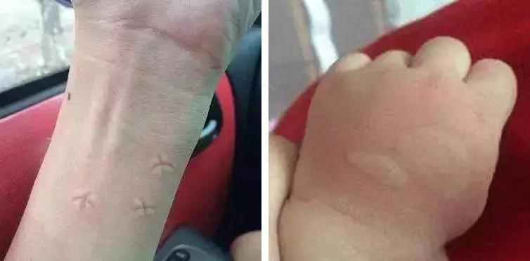 夏天蚊虫来袭,夏天蚊子太多用什么驱蚊神器