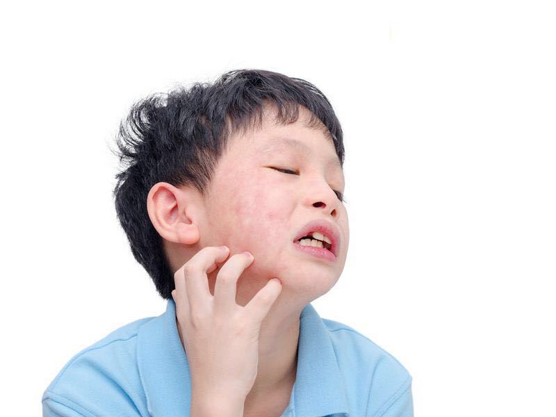 孩子皮肤过敏怎么治最快最有效,孩子皮肤过敏最快缓解方法