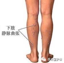 大隐静脉曲张实验,南京大隐静脉曲张