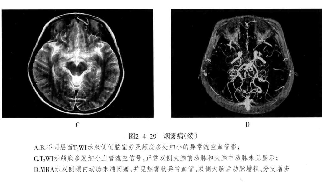 颅内血管周围间隙的影像鉴别,颅脑血管源性疾病影像诊断