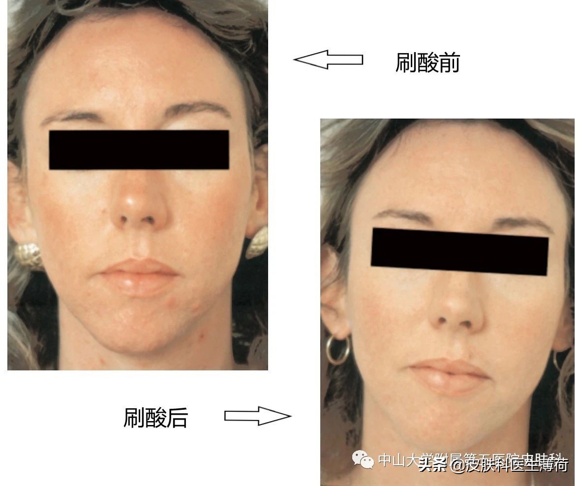 刷酸用果酸还是水杨酸,医生不会告诉你祛脚气的秘密
