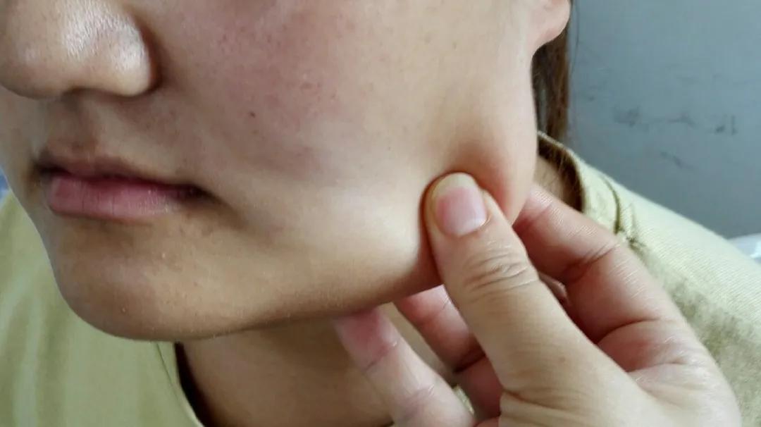 解密瘦脸针的几大常识性问题,关于瘦脸针的几个常识问题