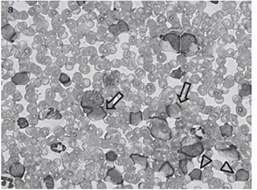 干细胞可以治疗代谢疾病吗,代谢性疾病中国有办法根治吗