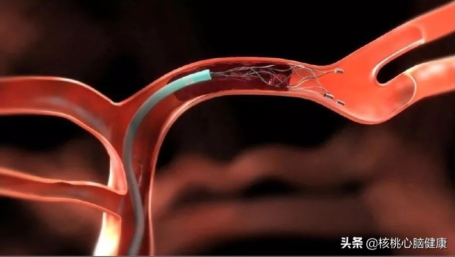 突发脑梗怎么急救最好的方法,疏通血管的药水对脑梗有好处吗