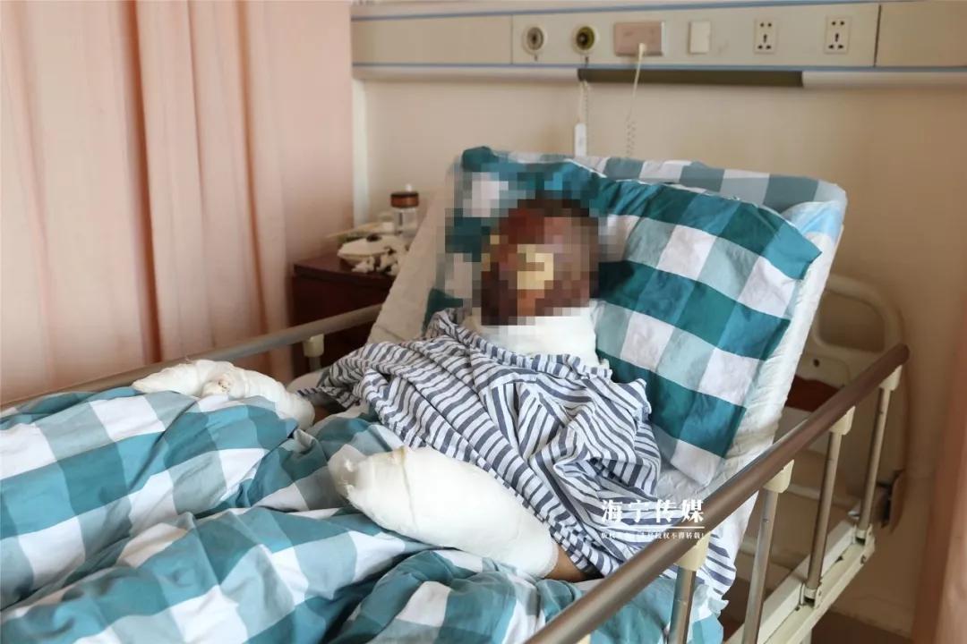 手机爆炸炸伤人严重事故,手机爆炸烧伤事件