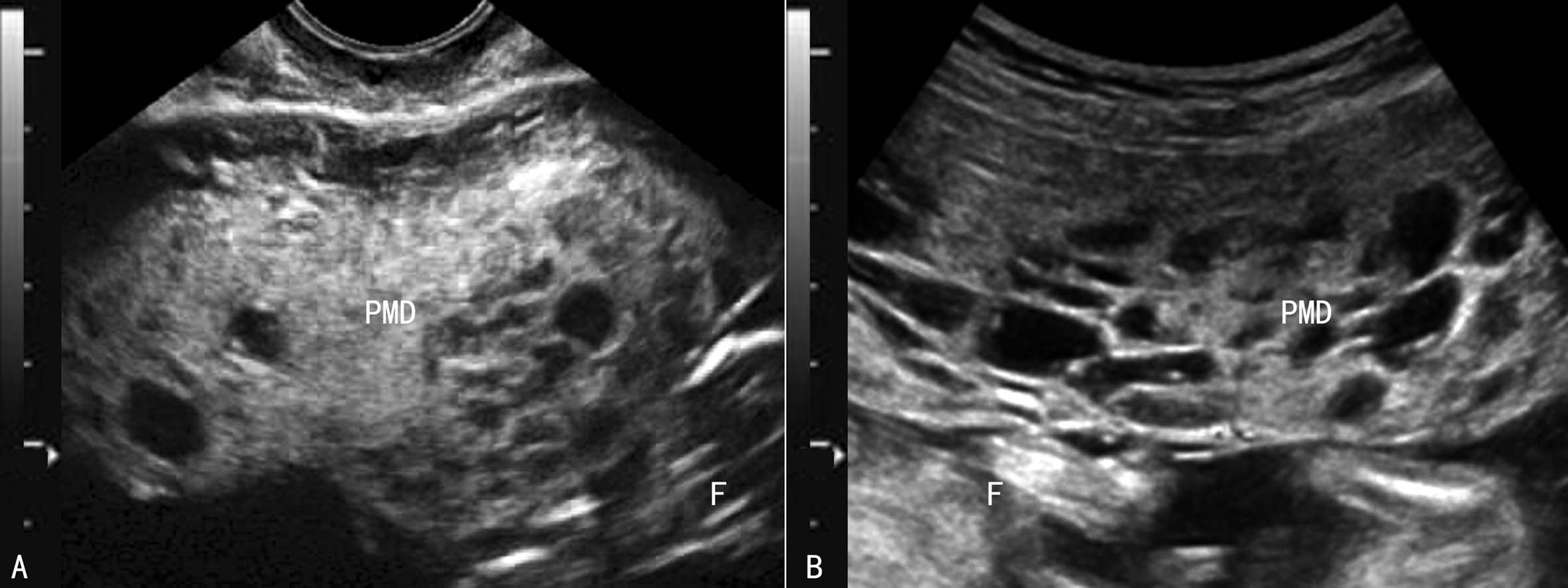 胎盘异常的超声表现,胎盘的异常超声