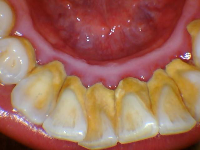 牙缝很臭？口腔有异味？你刷牙方式对过吗？